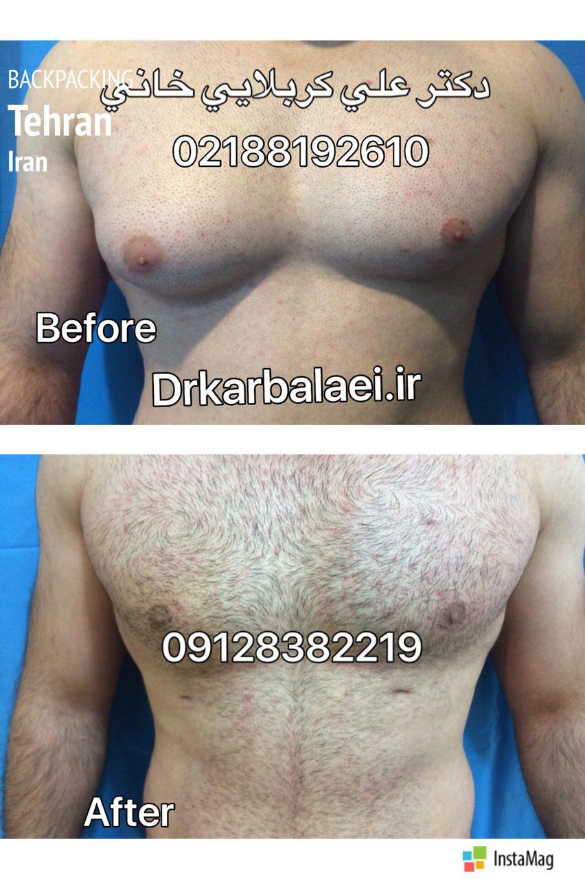 gynecomastia